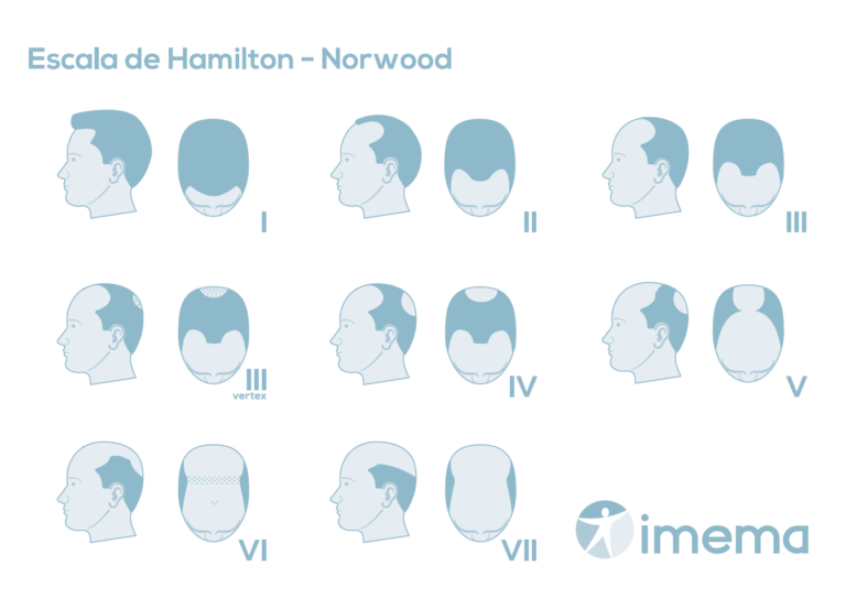 Imagen escala de Hamilton NorwoodNuevos Tratamientos para la Alopecia Androgénica en Madrid