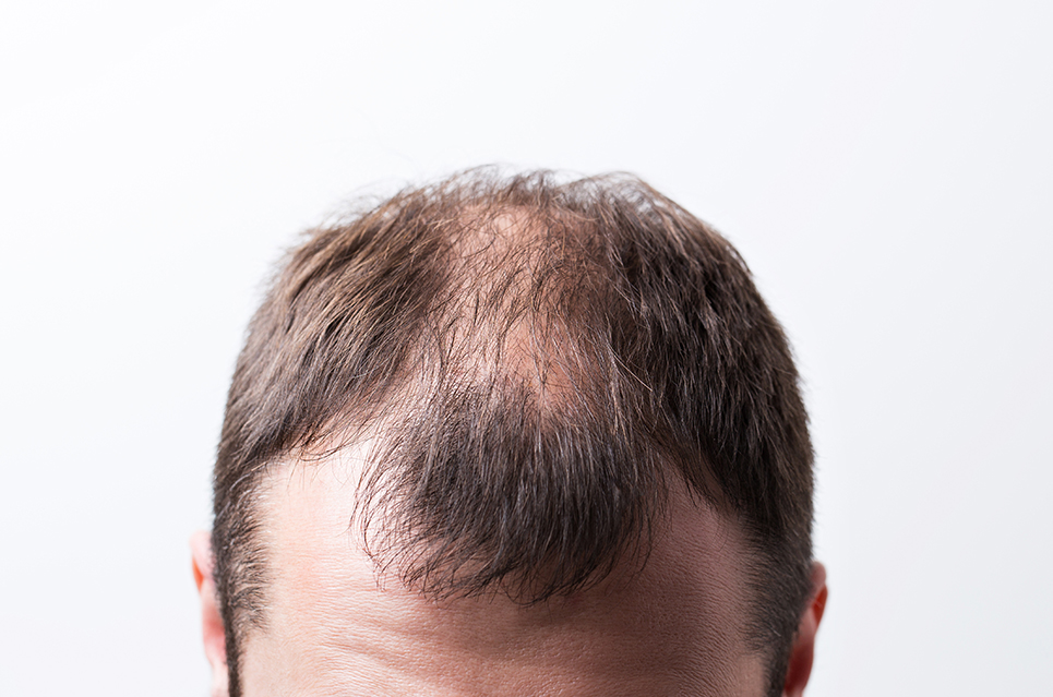 Nuevos Tratamientos para la Alopecia Androgénica en Madrid